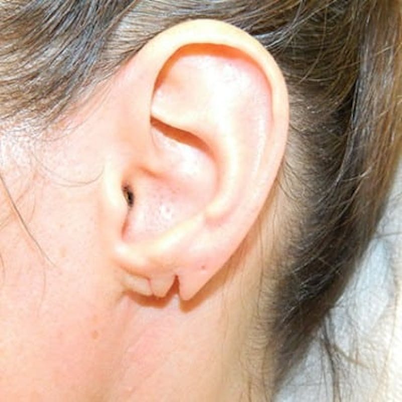 Earlobe Repair Before & After Gallery - Patient 133066436 - Image 1