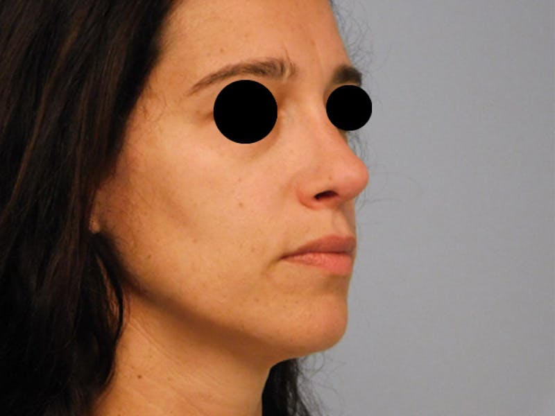 Revision Rhinoplasty Before & After Gallery - Patient 133066439 - Image 8