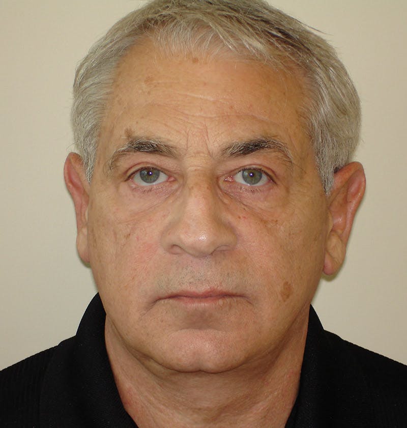 Otoplasty Before & After Gallery - Patient 133066435 - Image 2