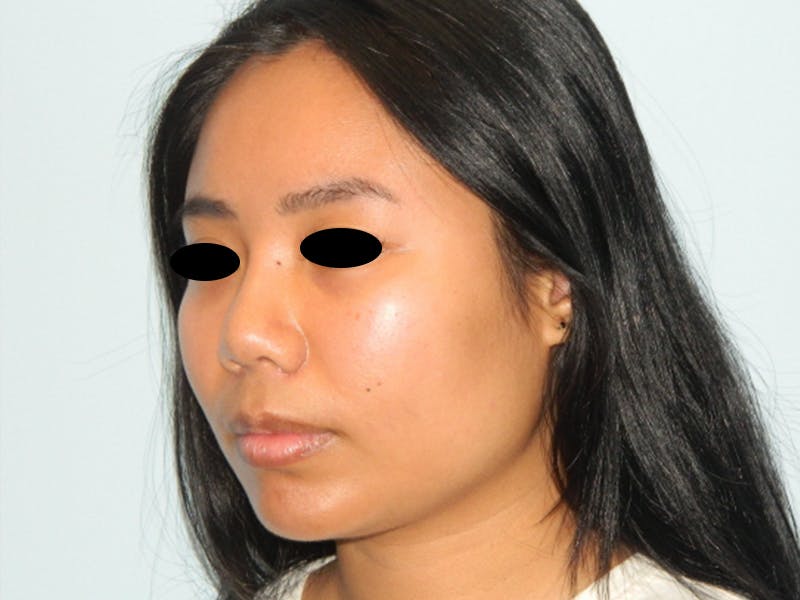 Neck (Submental) Liposuction Before & After Gallery - Patient 133066437 - Image 8