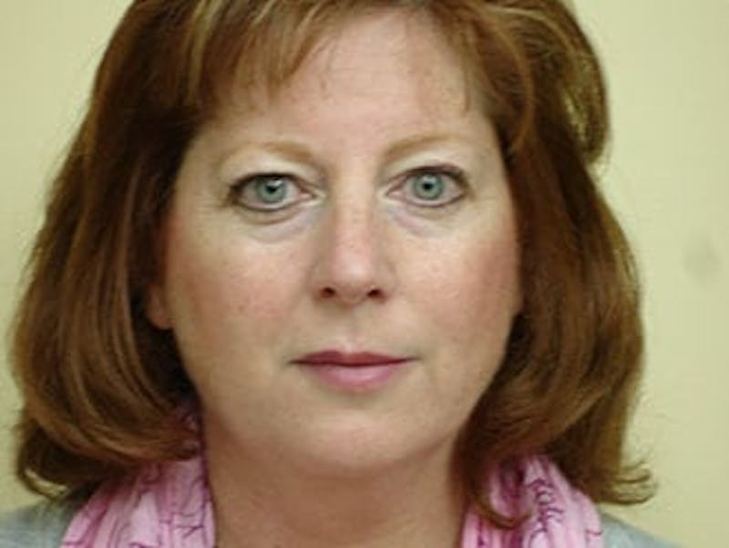 Facelift Before & After Gallery - Patient 133066442 - Image 3