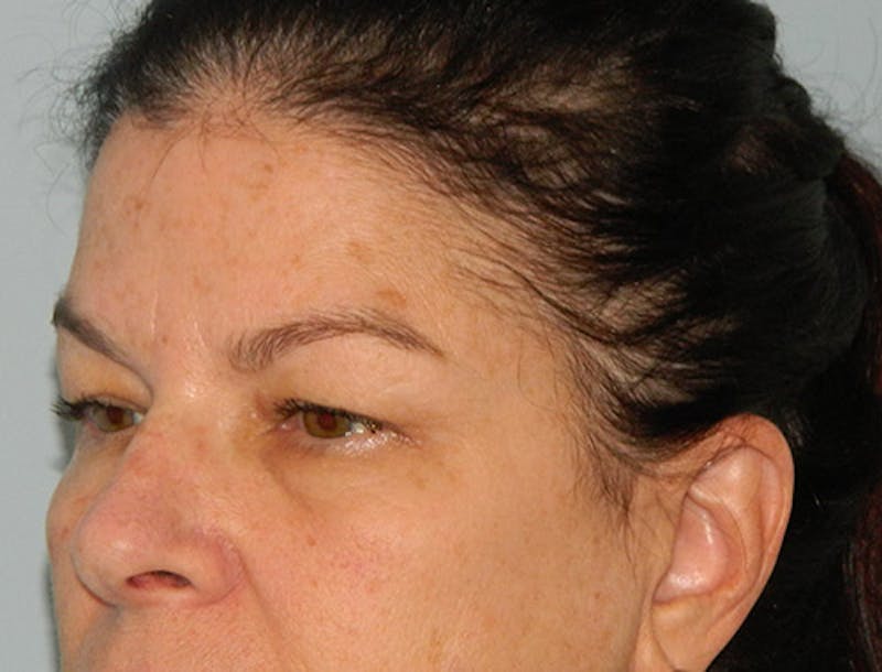 Blepharoplasty (Eyelid Lift) Before & After Gallery - Patient 133066438 - Image 3