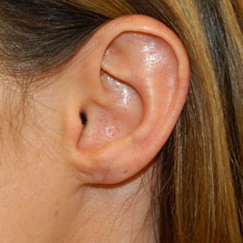 Earlobe Repair Before & After Gallery - Patient 133066436 - Image 2