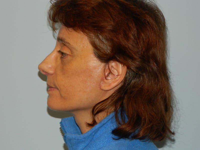 Mini-Facelift Before & After Gallery - Patient 133066440 - Image 4