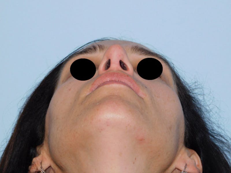 Revision Rhinoplasty Before & After Gallery - Patient 133066439 - Image 10