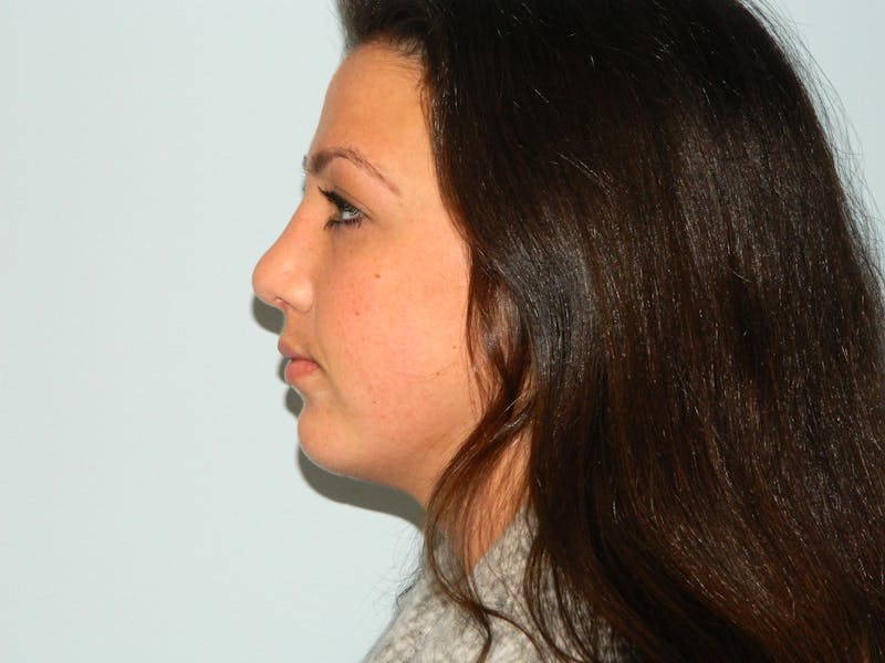 Chin Augmentation Before & After Gallery - Patient 133066448 - Image 4