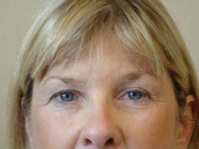 Blepharoplasty (Eyelid Lift) Before & After Gallery - Patient 133066443 - Image 1