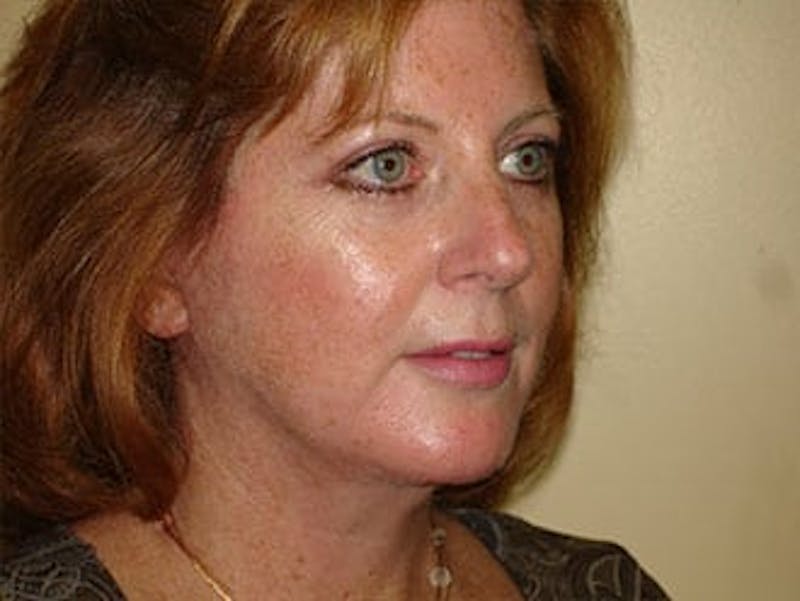 Facelift Before & After Gallery - Patient 133066442 - Image 6