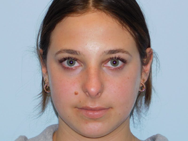Rhinoplasty Before & After Gallery - Patient 133066450 - Image 5