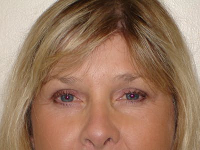 Blepharoplasty (Eyelid Lift) Before & After Gallery - Patient 133066443 - Image 2