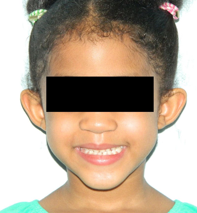 Otoplasty Before & After Gallery - Patient 133066445 - Image 1