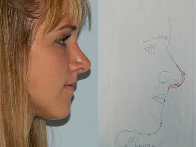 Revision Rhinoplasty Before & After Gallery - Patient 133066451 - Image 2