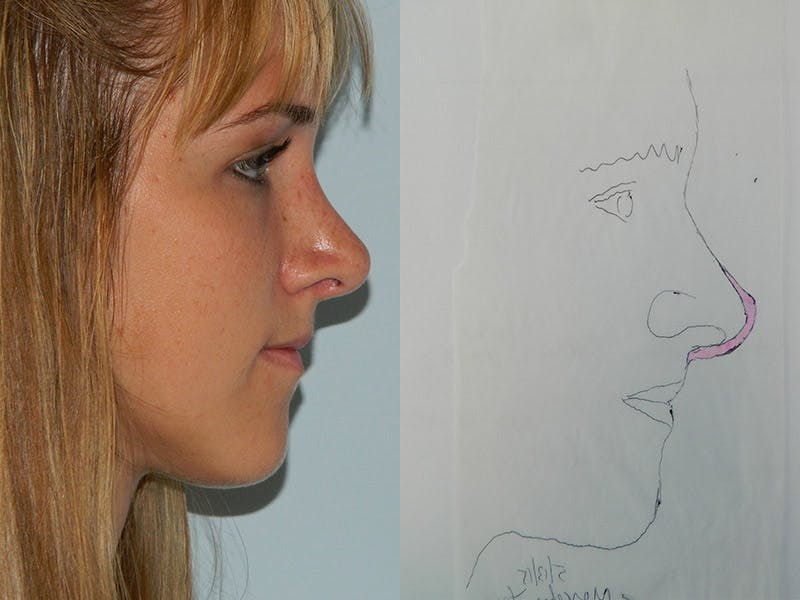 Revision Rhinoplasty Before & After Gallery - Patient 133066451 - Image 2