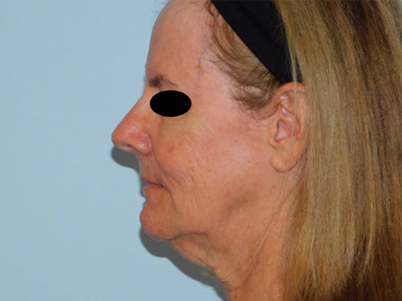Facelift Before & After Gallery - Patient 133066447 - Image 1