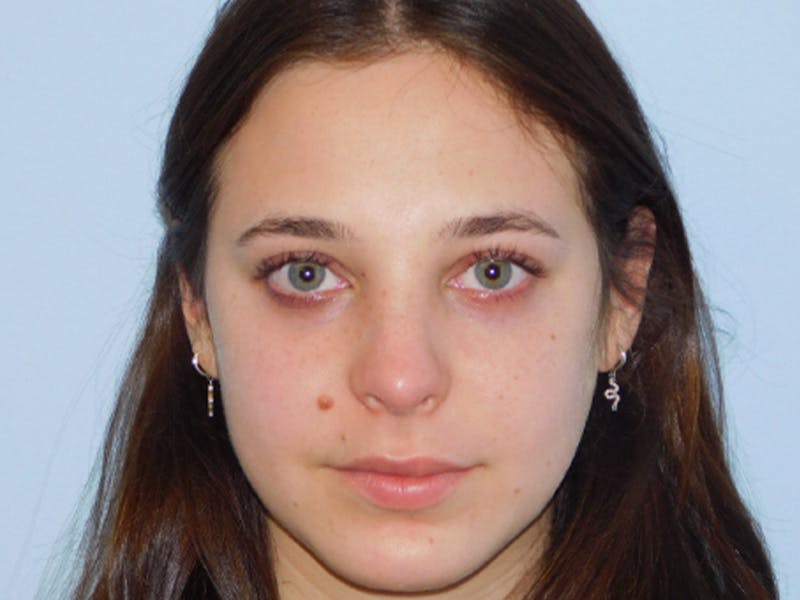 Rhinoplasty Before & After Gallery - Patient 133066450 - Image 6
