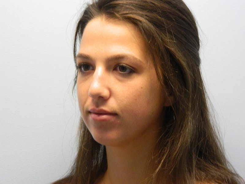 Chin Augmentation Before & After Gallery - Patient 133066448 - Image 5