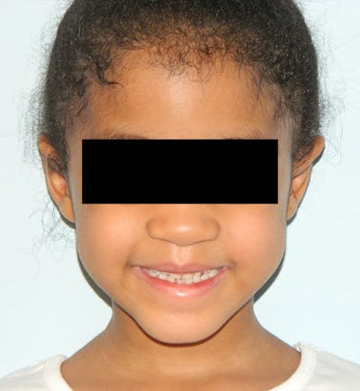 Otoplasty Before & After Gallery - Patient 133066445 - Image 2
