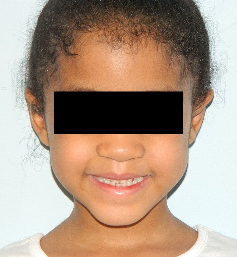 Otoplasty Before & After Gallery - Patient 133066445 - Image 2