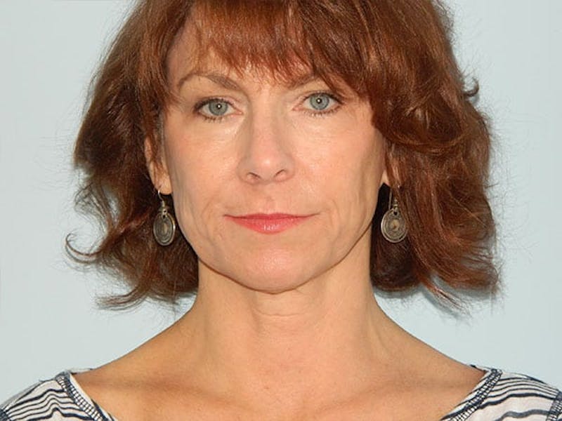 Mini-Facelift Before & After Gallery - Patient 133066444 - Image 3