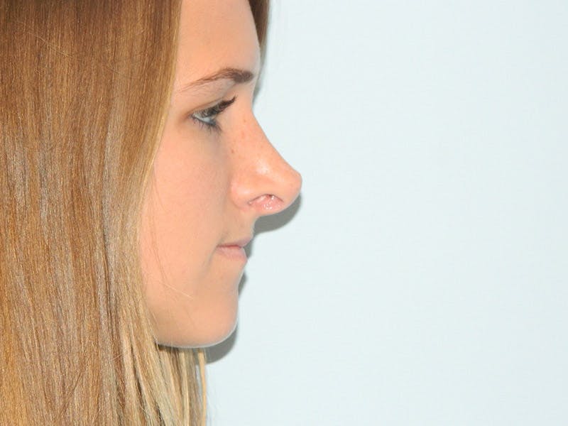 Revision Rhinoplasty Before & After Gallery - Patient 133066451 - Image 3