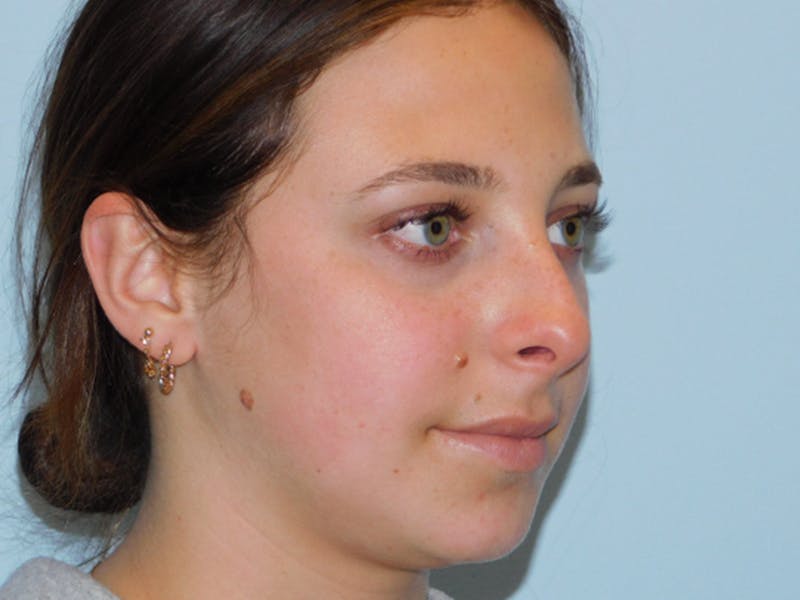 Rhinoplasty Before & After Gallery - Patient 133066450 - Image 7