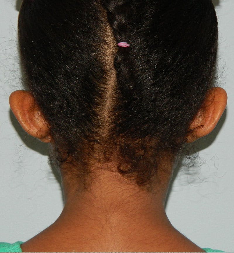 Otoplasty Before & After Gallery - Patient 133066445 - Image 3