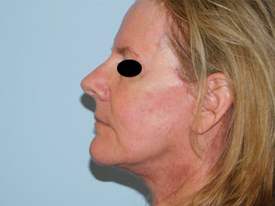 Facelift Before & After Gallery - Patient 133066447 - Image 2