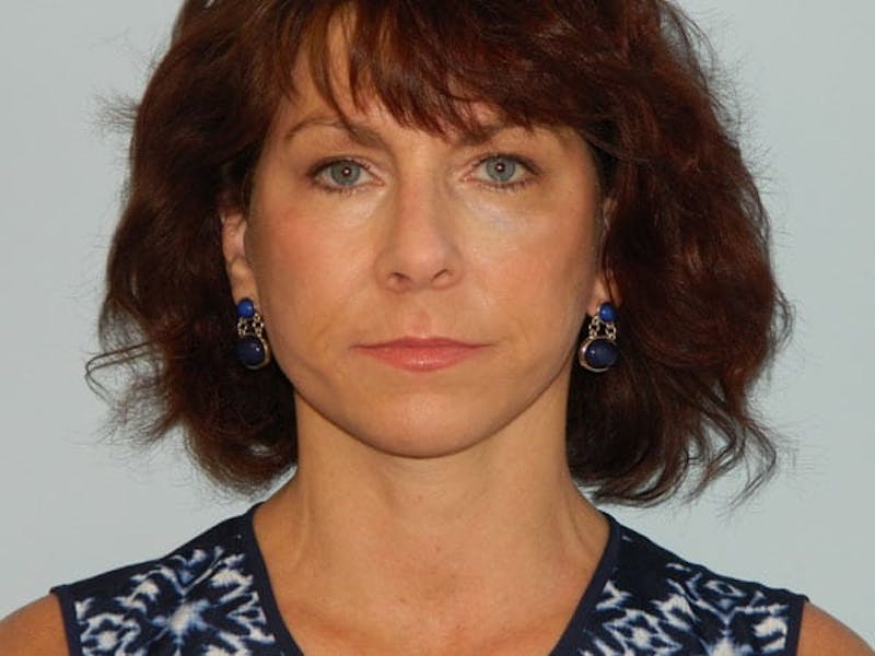 Mini-Facelift Before & After Gallery - Patient 133066444 - Image 4