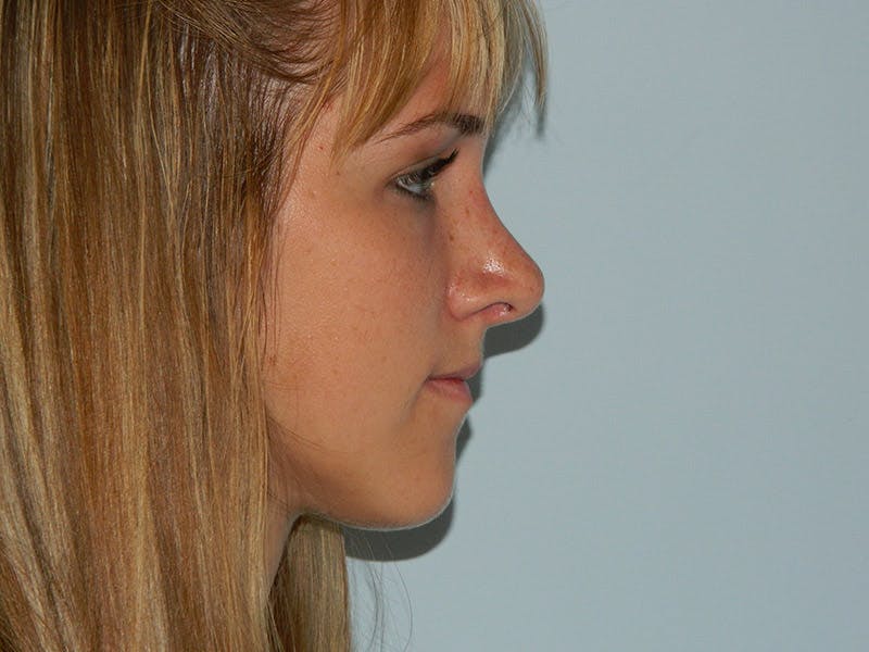 Revision Rhinoplasty Before & After Gallery - Patient 133066451 - Image 4