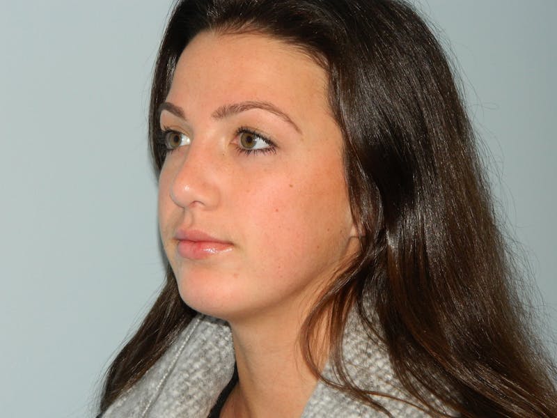 Chin Augmentation Before & After Gallery - Patient 133066448 - Image 6