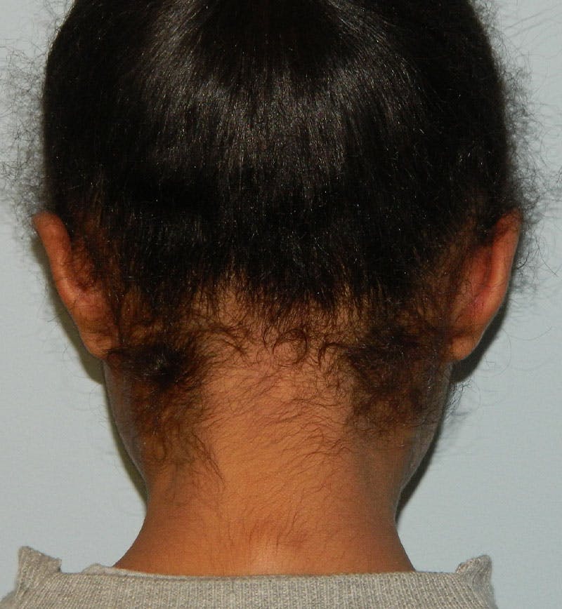 Otoplasty Before & After Gallery - Patient 133066445 - Image 4