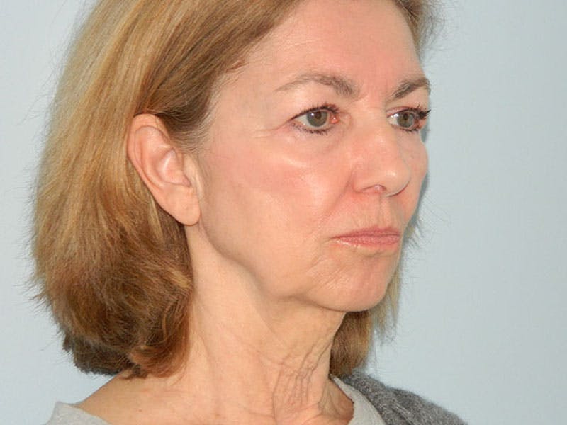 Mini-Facelift Before & After Gallery - Patient 133066458 - Image 1