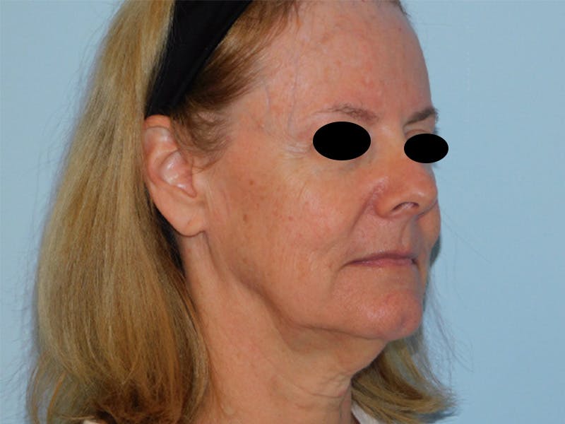 Facelift Before & After Gallery - Patient 133066447 - Image 3