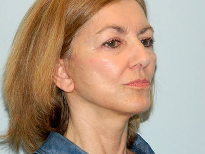 Mini-Facelift Before & After Gallery - Patient 133066458 - Image 2