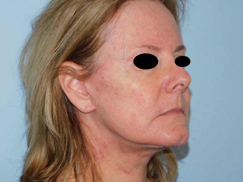 Facelift Before & After Gallery - Patient 133066447 - Image 4
