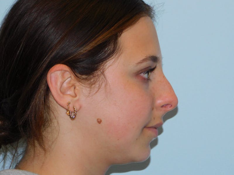 Rhinoplasty Before & After Gallery - Patient 133066450 - Image 9
