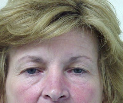 Blepharoplasty (Eyelid Lift) Before & After Gallery - Patient 133066449 - Image 1