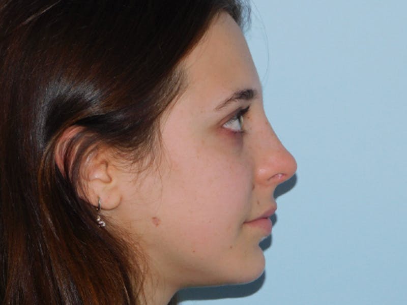 Rhinoplasty Before & After Gallery - Patient 133066450 - Image 10