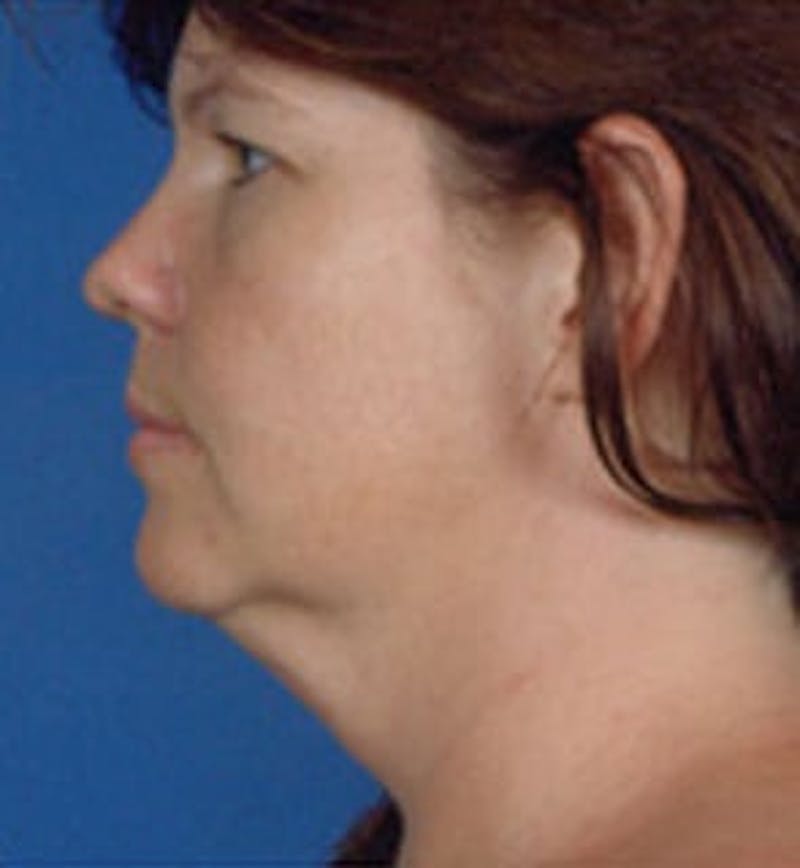 Facelift Before & After Gallery - Patient 133066452 - Image 1