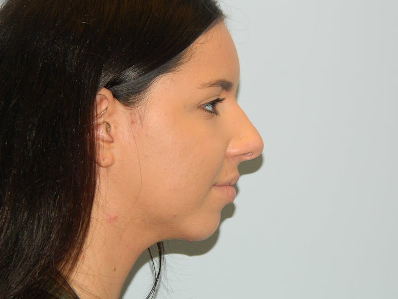 Chin Augmentation Before & After Gallery - Patient 133066473 - Image 1