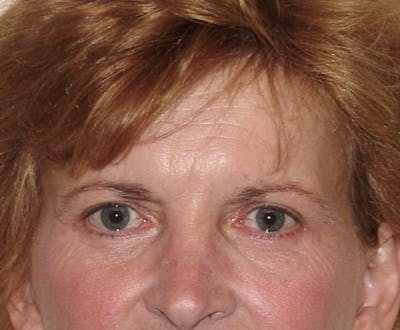 Blepharoplasty (Eyelid Lift) Before & After Gallery - Patient 133066449 - Image 2