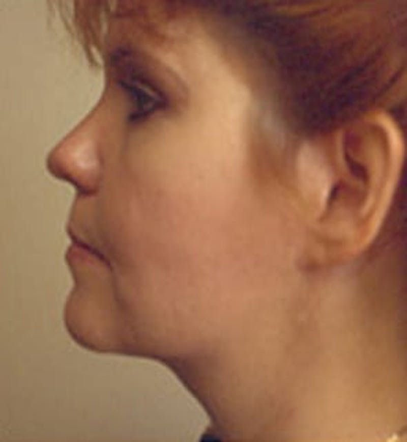 Facelift Before & After Gallery - Patient 133066452 - Image 2
