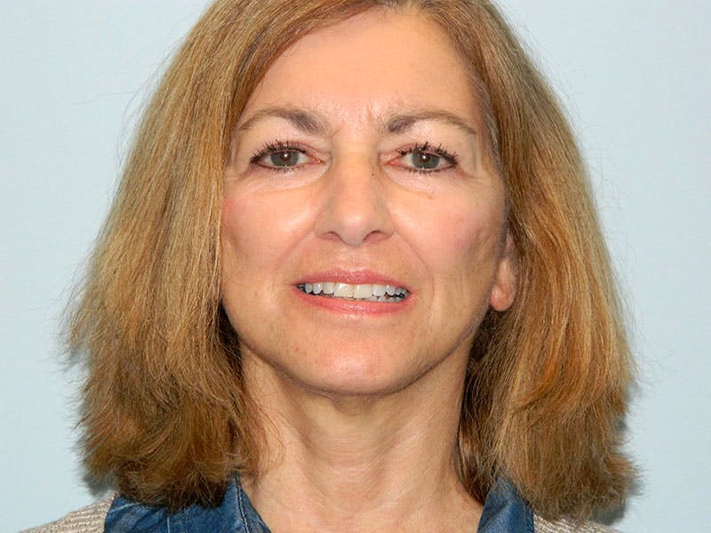 Mini-Facelift Before & After Gallery - Patient 133066458 - Image 4