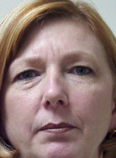 Blepharoplasty (Eyelid Lift) Before & After Gallery - Patient 133066455 - Image 1