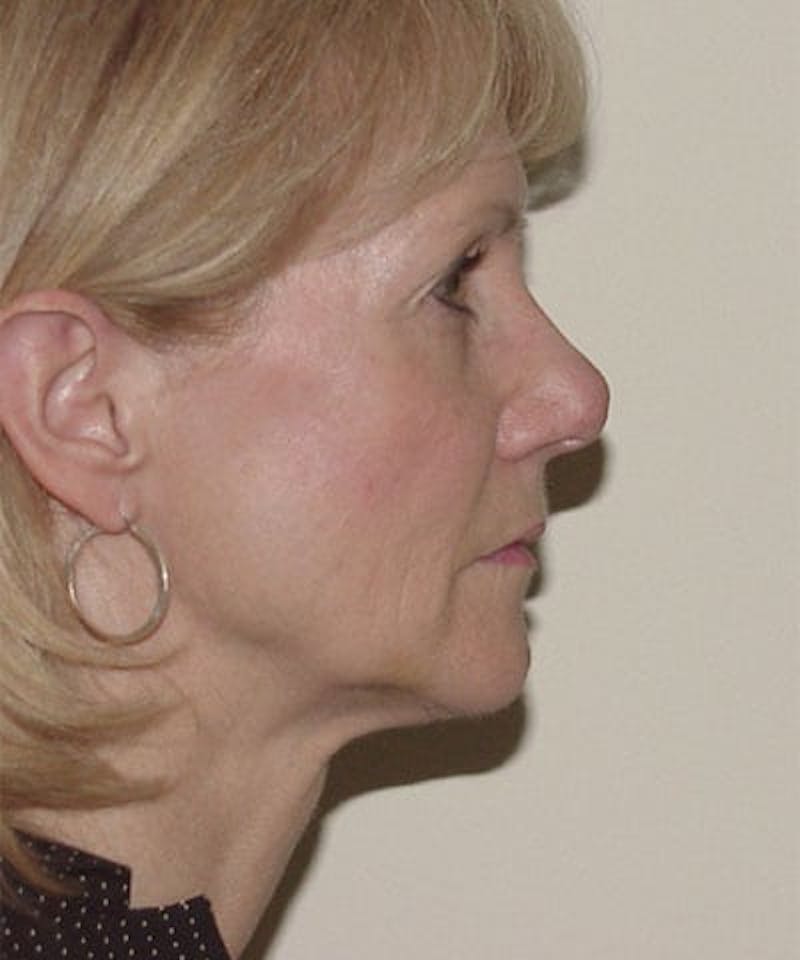 Facelift Before & After Gallery - Patient 133066460 - Image 1