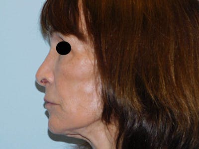 Revision Rhinoplasty Before & After Gallery - Patient 133066464 - Image 1