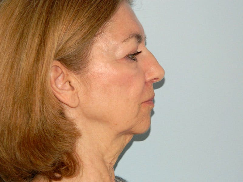 Mini-Facelift Before & After Gallery - Patient 133066458 - Image 5