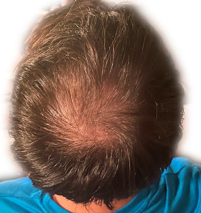 PRP Injections for Hair Loss Before & After Gallery - Patient 133066459 - Image 1