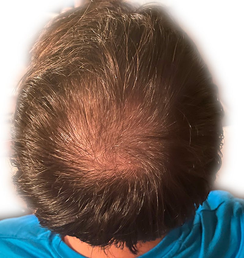 PRP Injections for Hair Loss Before & After Gallery - Patient 133066459 - Image 1