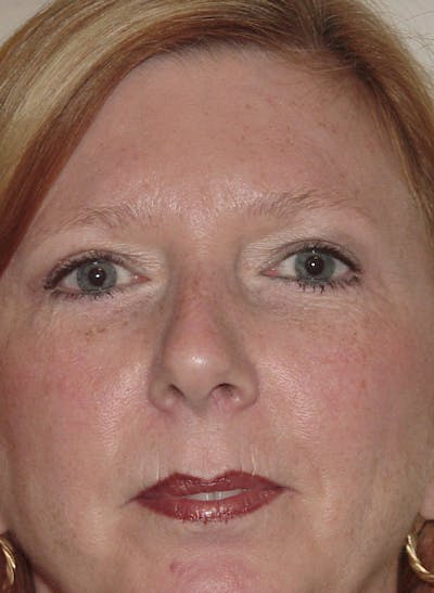 Blepharoplasty (Eyelid Lift) Before & After Gallery - Patient 133066455 - Image 2